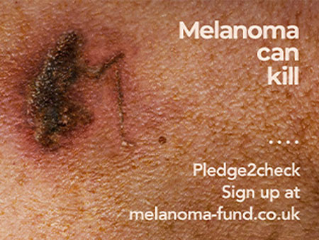 Melanoma